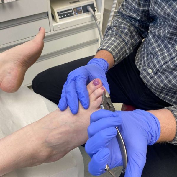 Adelaide Podiatrist, Sebastian Bower, managing an ingrown toenail.