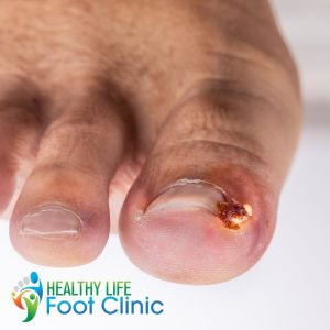 Adelaide Podiatrist, Ingrown Toenails